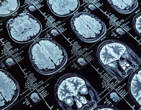 Resonancia magnética cerebral mostrando múltiples tuberculomas con captación de contraste en anillo