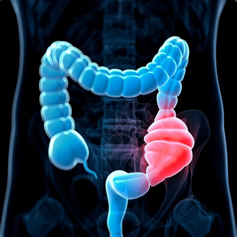 Esquema de las complicaciones del estreñimiento en el intestino