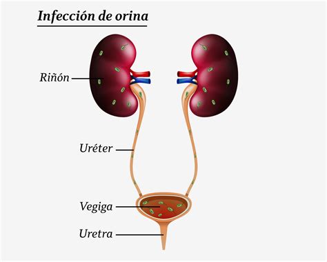 Diagrama mostrando la trayectoria de una infección urinaria ascendente hacia los riñones.