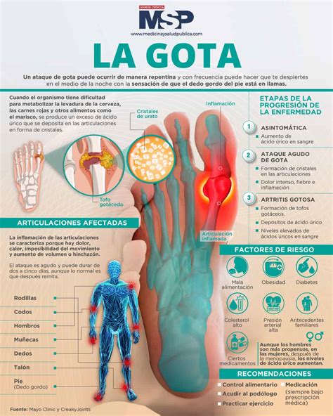 infografía sobre la prevalencia de gota por grupos de edad y sexo