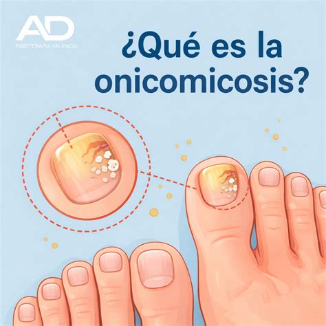 Fotos comparativas de uñas sanas y con onicomicosis en adultos mayores