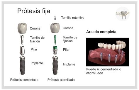 Esquema de un implante dental y su integración ósea