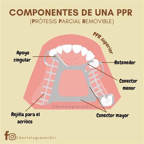 Esquema de las partes de una prótesis dental removible