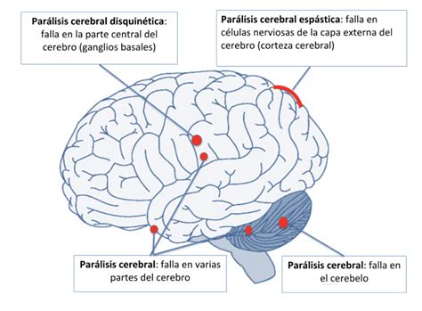Esquema ilustrativo del cerebro y las áreas afectadas por la parálisis cerebral.
