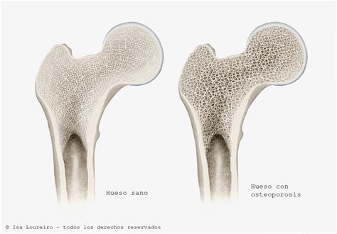 esquema comparativo de un hueso sano y un hueso con osteoporosis
