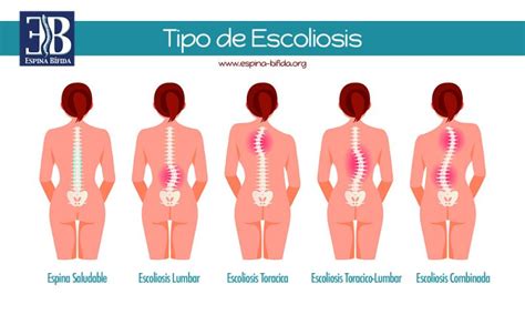 Esquema de las diferentes clasificaciones de escoliosis por edad y tipo (idiopática, congénita, neuromuscular)