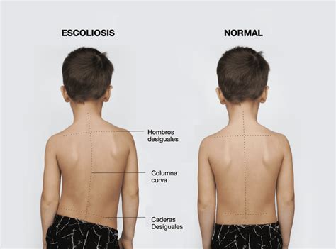 Diagrama mostrando la asimetría corporal causada por escoliosis (hombros, pelvis)