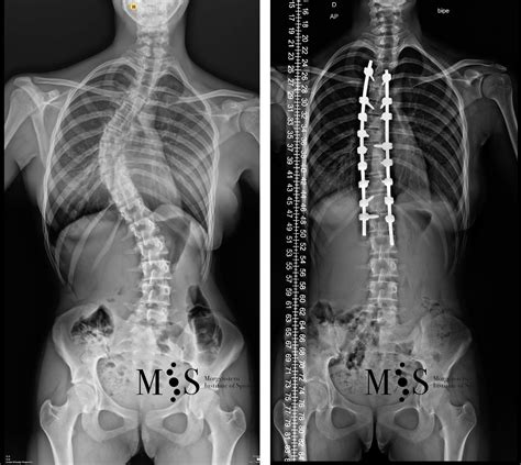 Radiografía de una columna vertebral mostrando escoliosis