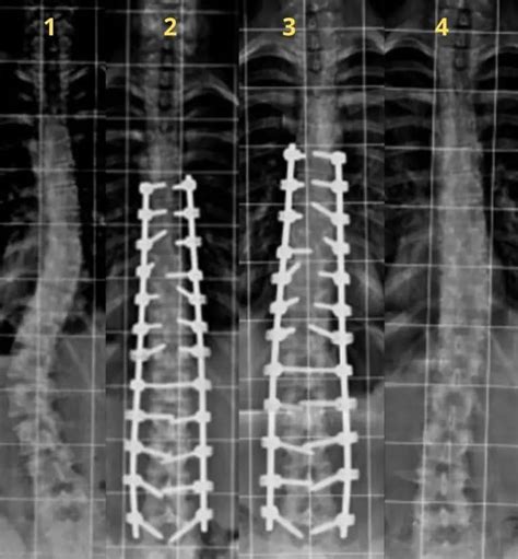 Esquema de una cirugía de escoliosis con varillas y tornillos en la columna
