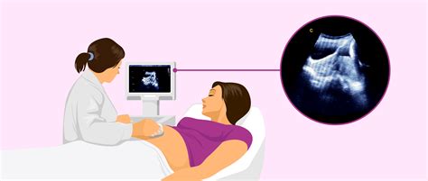 Ecografía transvaginal para el diagnóstico de placenta previa
