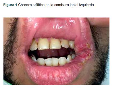 Fotografía de un chancro sifilítico en la región genital