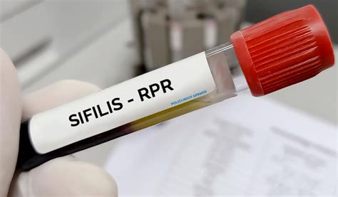 Ilustración de las pruebas de laboratorio para detectar la sífilis