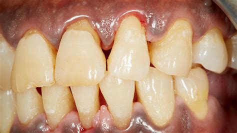 Esquema de dientes y encías con retracción gingival