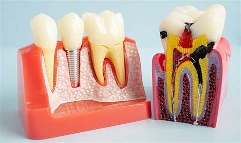 Diagrama de una caries en la raíz del diente