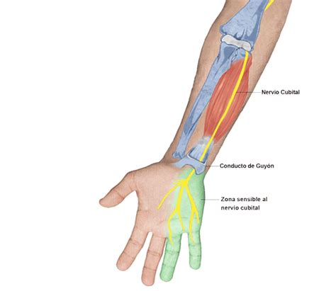 Diagrama: Zonas de afectación sensitiva y motora por lesiones de nervio mediano, radial y cubital en la mano