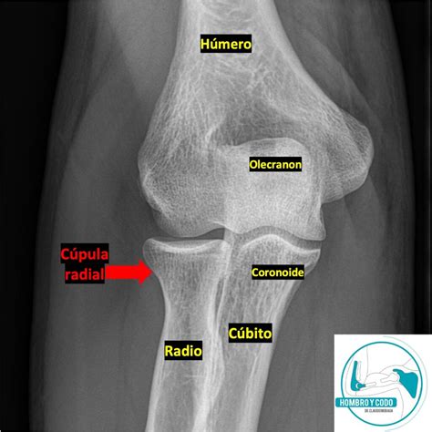 Radiografía de una fractura de codo