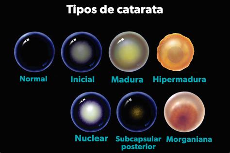 Fotografía clínica de un ojo con catarata en diferentes fases